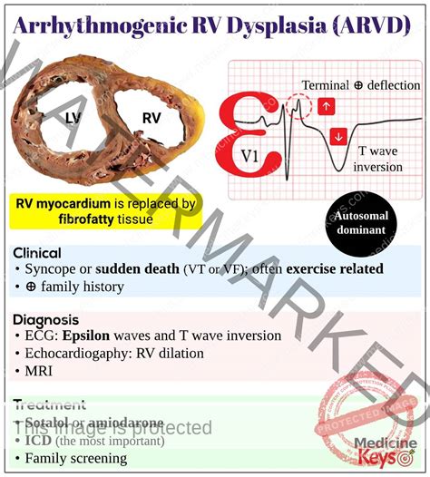 arrhythmogenic right ventricular dysplasia|right ventricular dysplasia treatment.